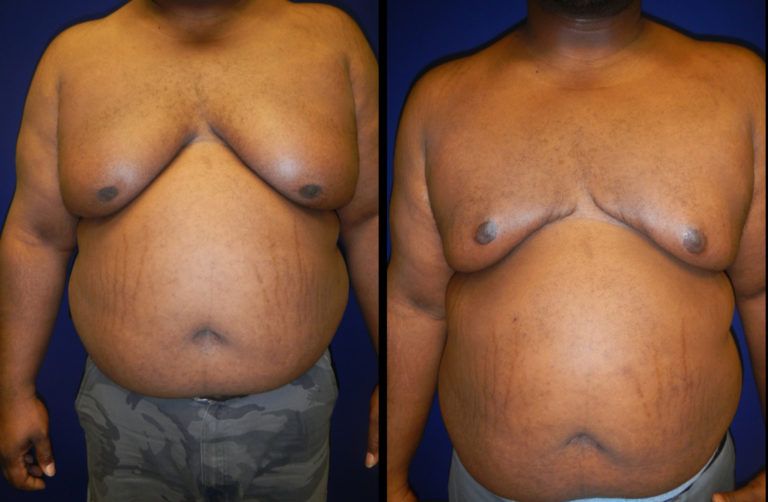 Male Breast Reduction Before & After