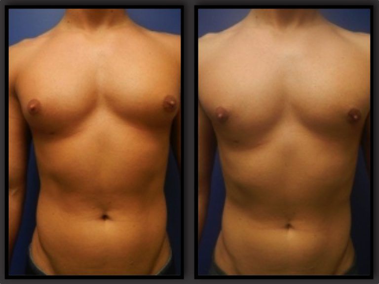 Male Breast Reduction Before & After