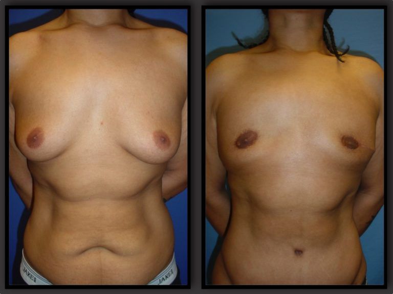 Male Breast Reduction Before & After