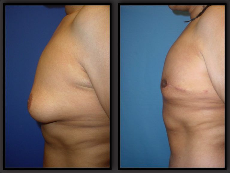 Male Breast Reduction Before & After