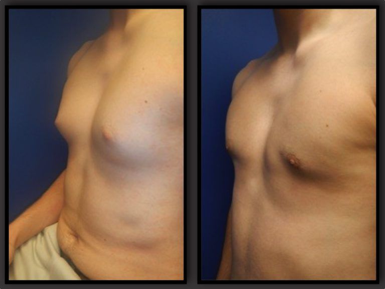 Male Breast Reduction Before & After