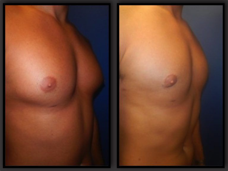 Male Breast Reduction Before & After