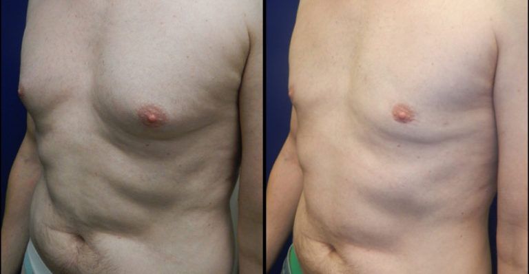 Male Breast Reduction Before & After