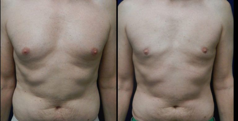 Male Breast Reduction Before & After