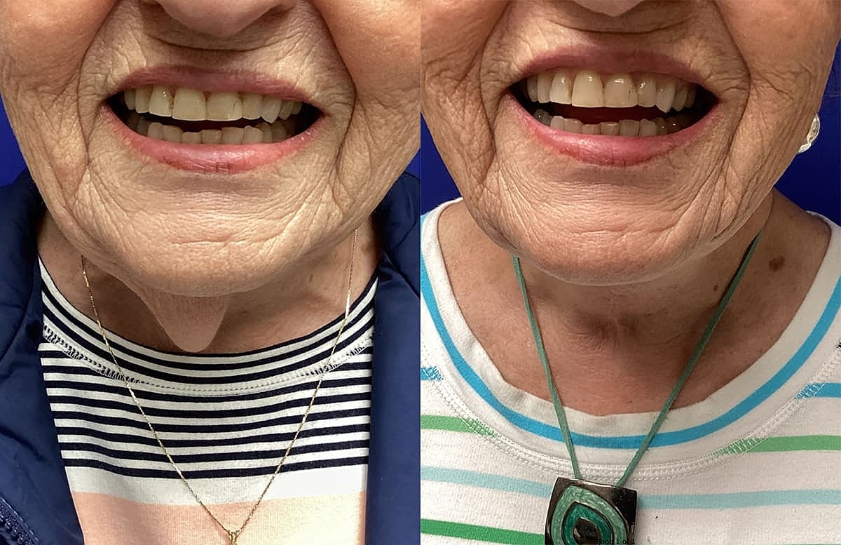 Smiling close-up of elderly woman’s faces.