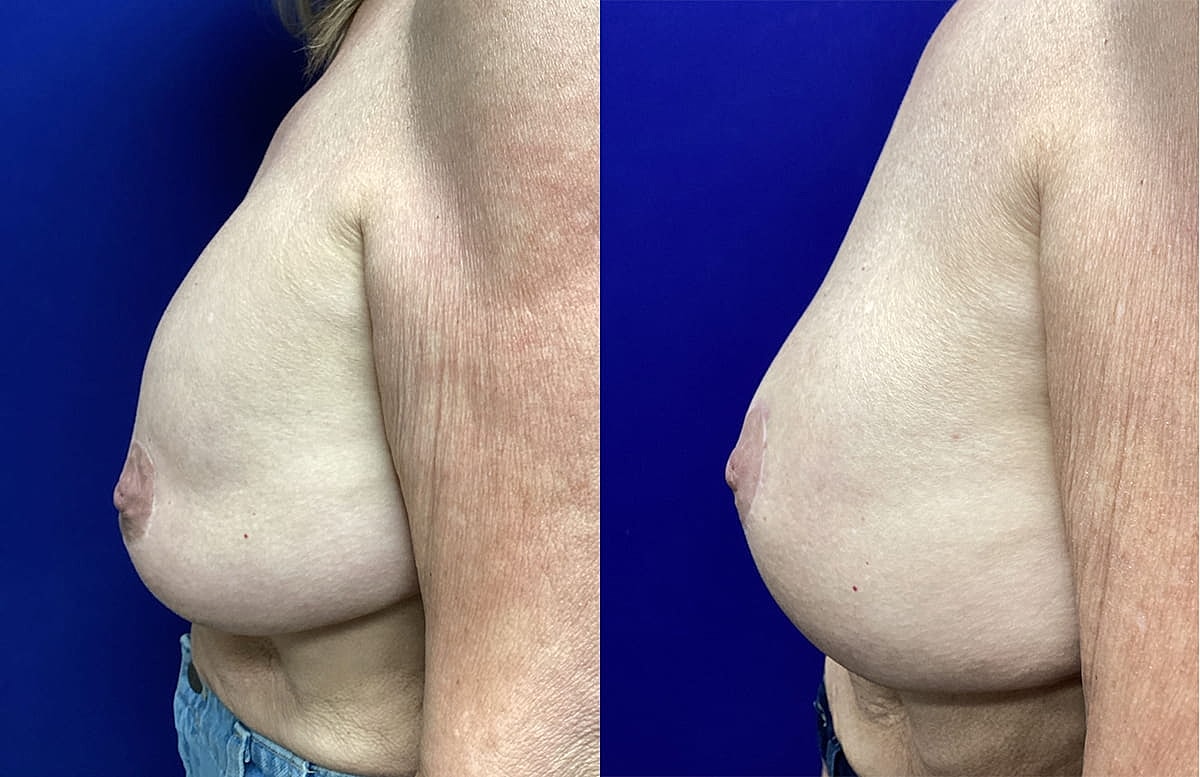 Side-by-side comparison of breast appearance.