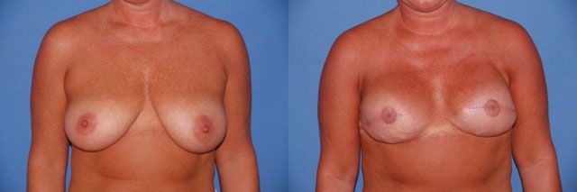 Breast Reconstruction Before & After