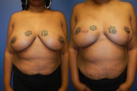 Breast Reconstruction Before & After
