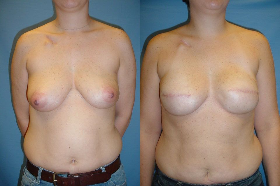 Breast Reconstruction Before & After