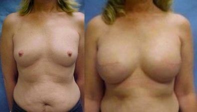 Breast Reconstruction Before & After