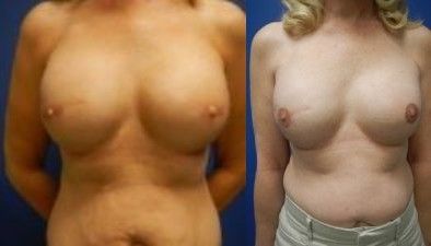Breast Reconstruction Before & After