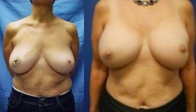 Breast Reconstruction Before & After