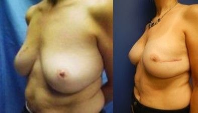 Breast Reconstruction Before & After