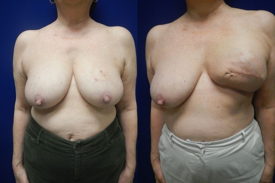 Breast Reconstruction Before & After
