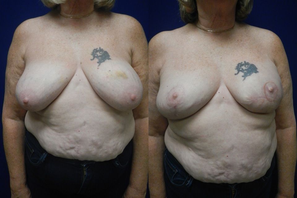 Breast Reconstruction Before & After