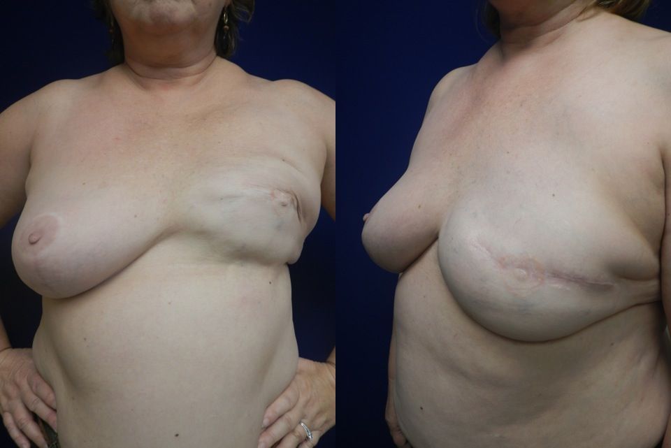 Breast Reconstruction Before & After