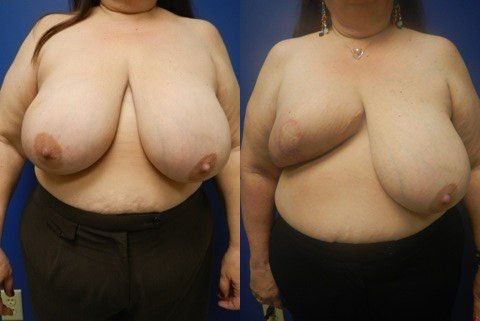 Breast Reconstruction Before & After