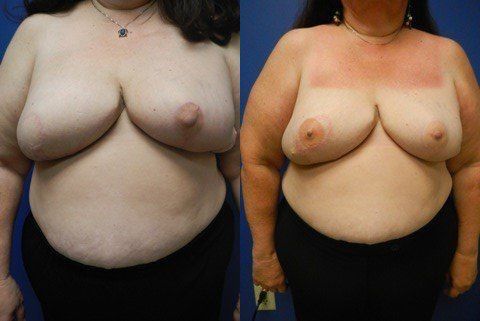 Breast Reconstruction Before & After