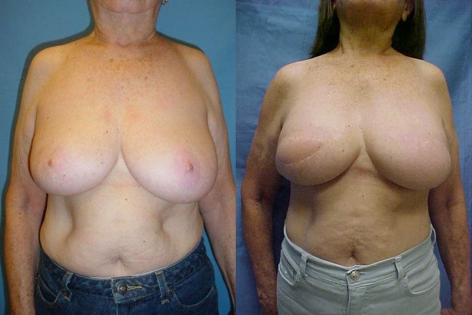 Breast Reconstruction Before & After