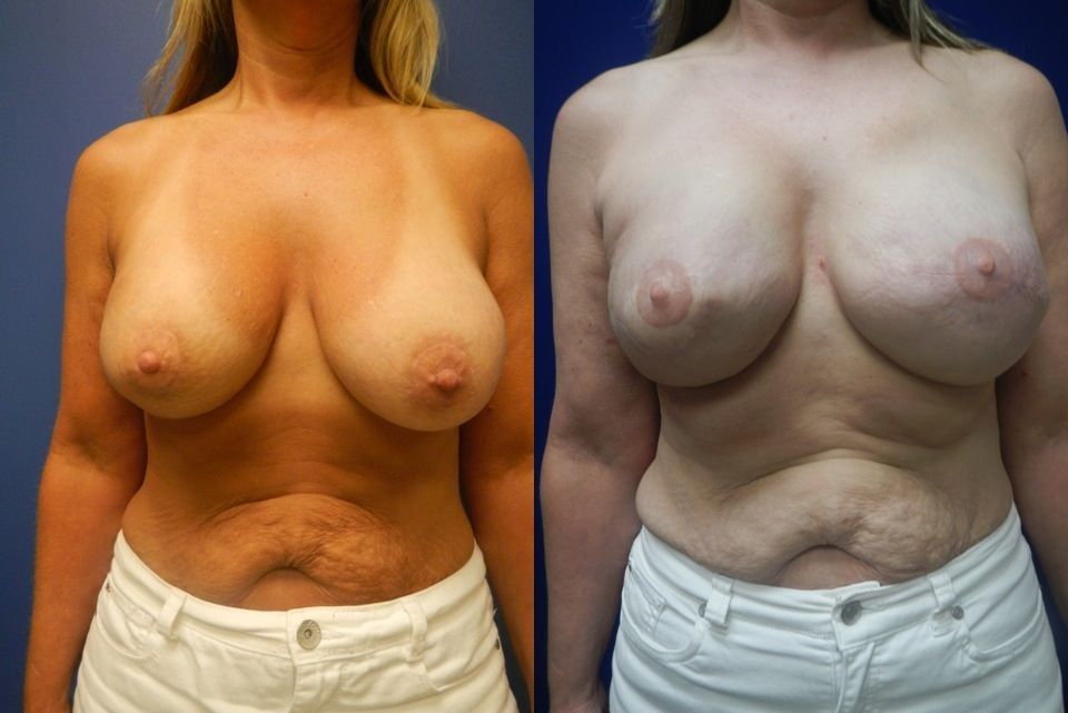Breast Reconstruction Before & After