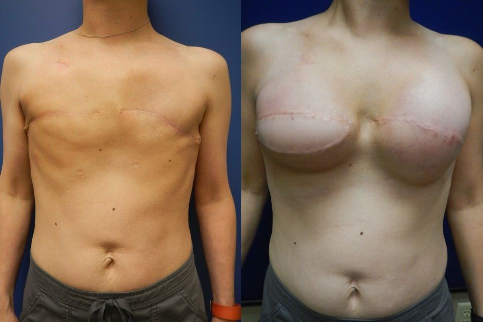 Breast Reconstruction Before & After