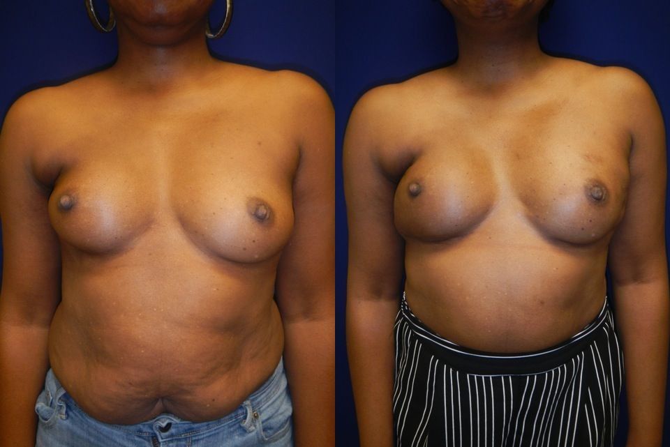 Breast Reconstruction Before & After