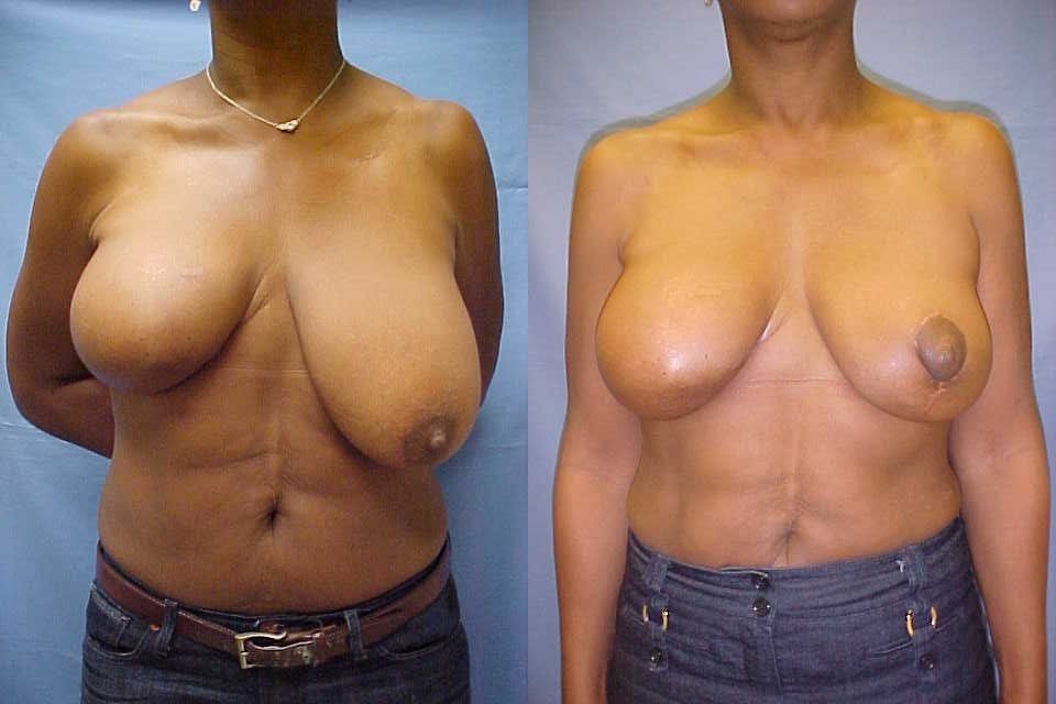 Breast Reconstruction Before & After