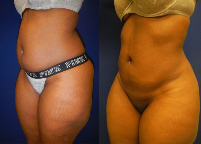 Liposuction Before & After