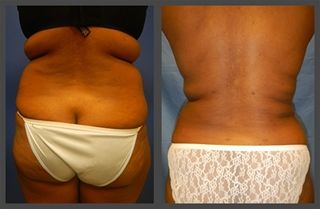 Liposuction Before & After