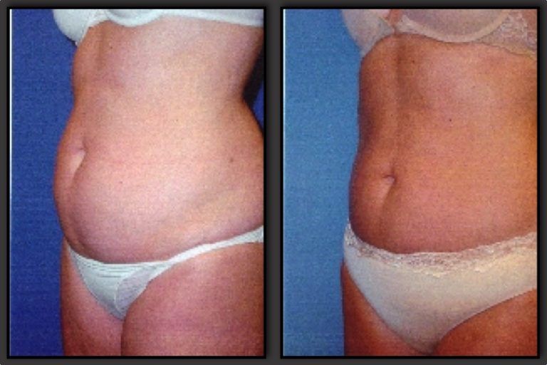 Liposuction Before & After