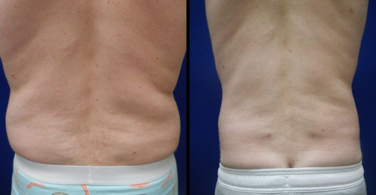 Liposuction Before & After