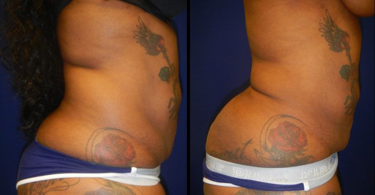 Liposuction Before & After