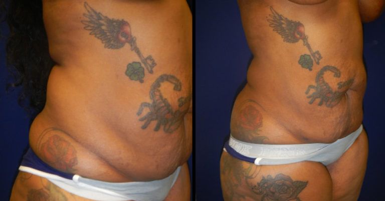 Liposuction Before & After