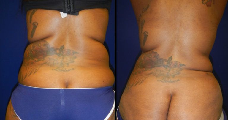Liposuction Before & After