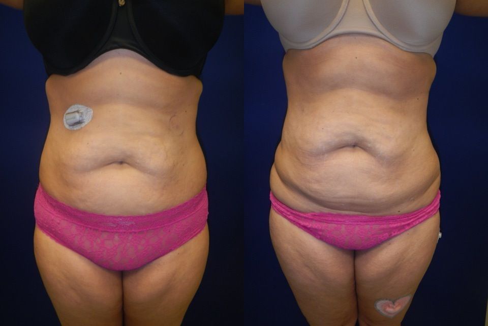 Liposuction Before & After