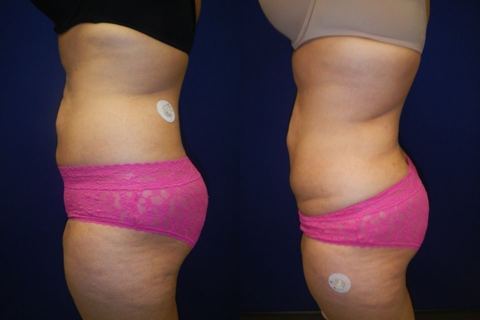 Liposuction Before & After