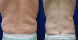 Liposuction Before & After