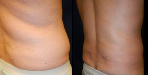 Liposuction Before & After