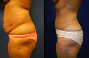 Liposuction Before & After