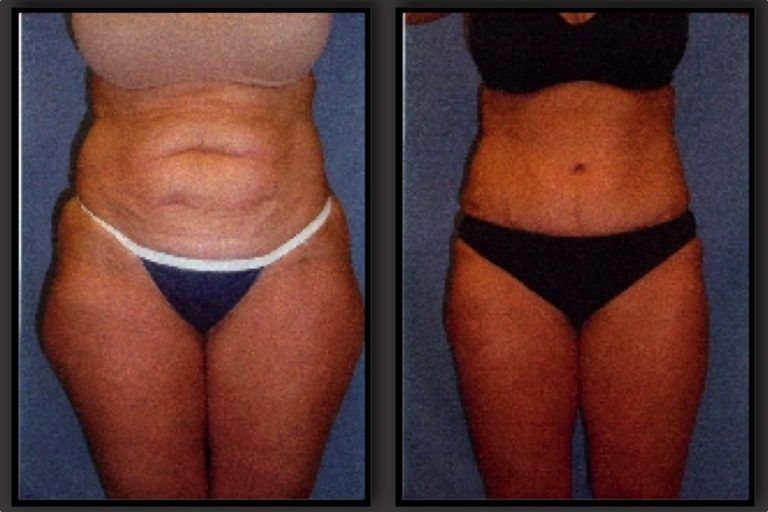 Tummy Tuck Before & After