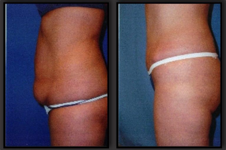 Tummy Tuck Before & After