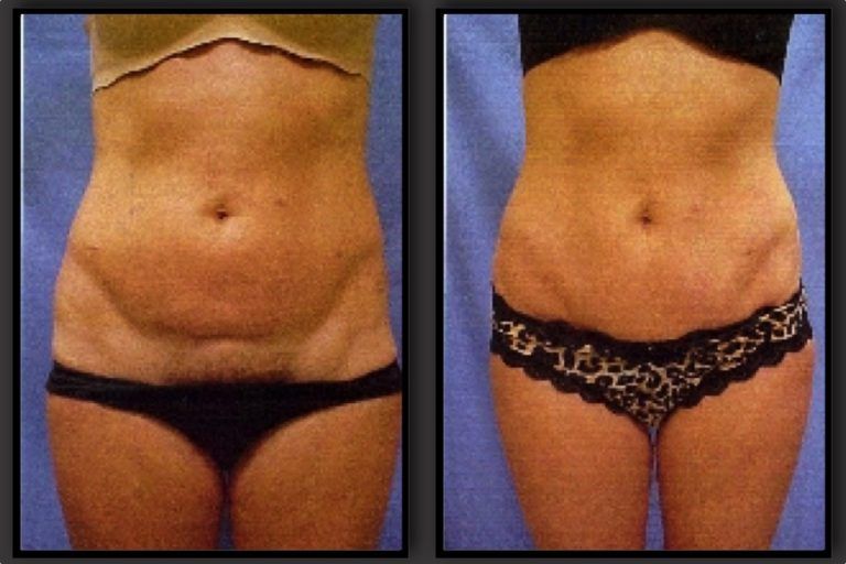 Tummy Tuck Before & After