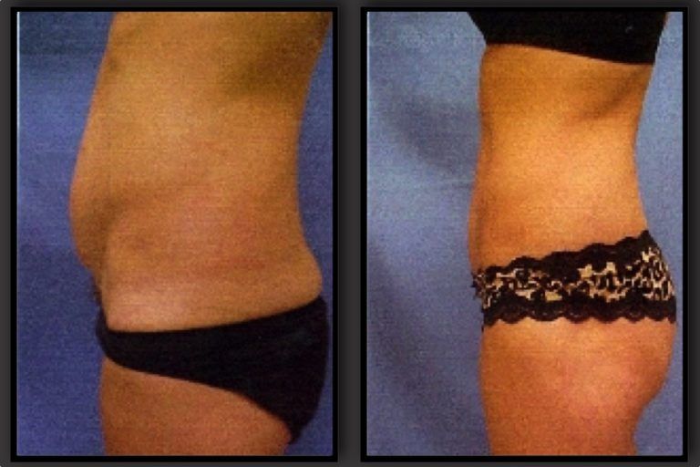 Tummy Tuck Before & After