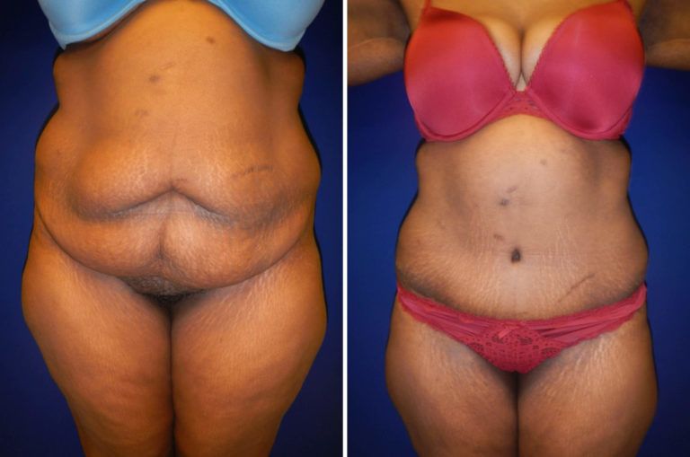 Tummy Tuck Before & After