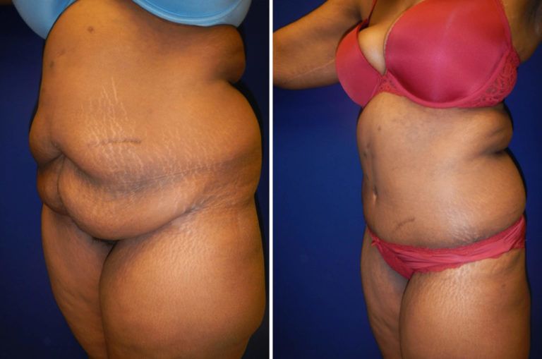 Tummy Tuck Before & After