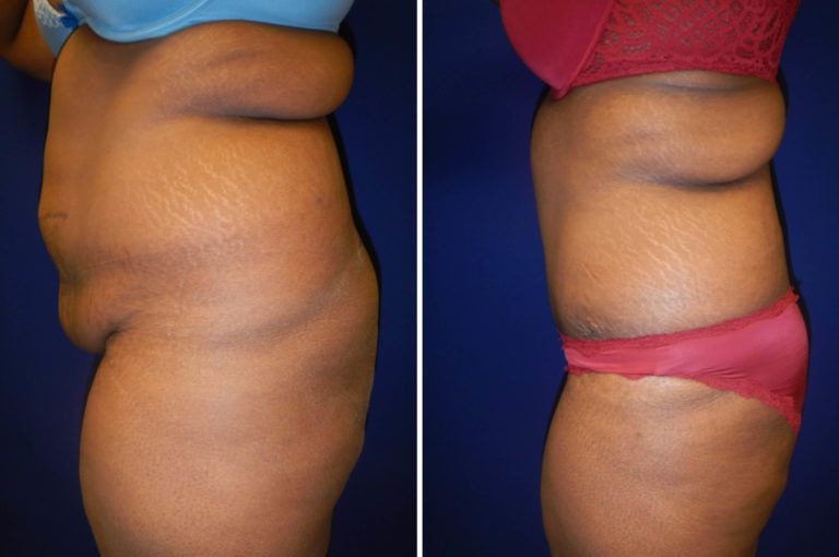 Tummy Tuck Before & After