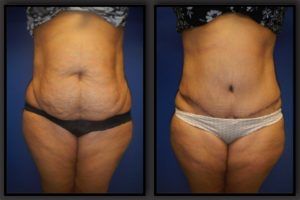 Tummy Tuck Before & After