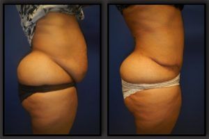 Tummy Tuck Before & After