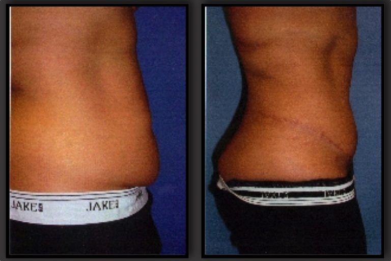 Tummy Tuck Before & After