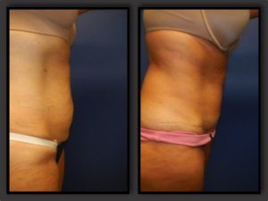 Tummy Tuck Before & After
